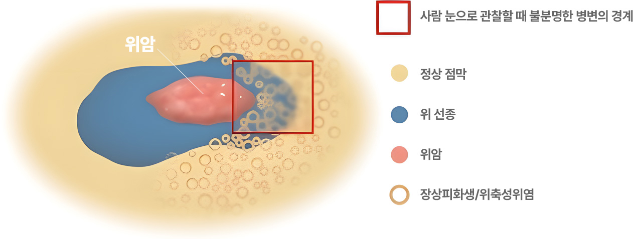 사람 눈으로 관찰할 때 불분명한 병변의 경계. 정상 점막, 위 선종, 위암, 장상피화생/위축성위염