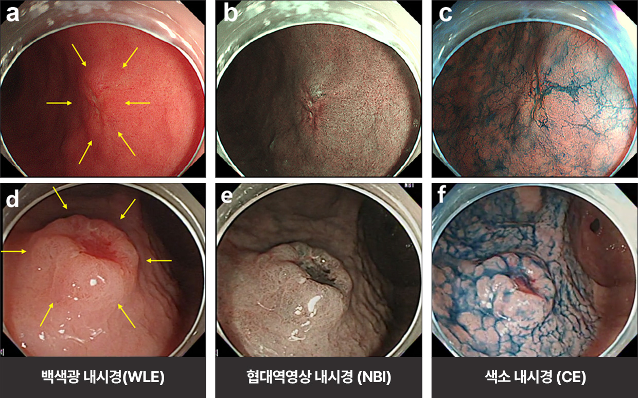 백색광 내시경(WLE) / 협대역영상 내시경 (NBI) / 색소 내시경 (CE)