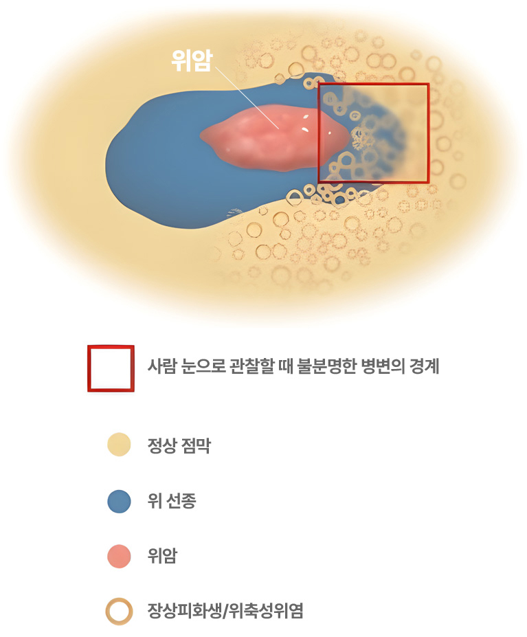 사람 눈으로 관찰할 때 불분명한 병변의 경계. 정상 점막, 위 선종, 위암, 장상피화생/위축성위염
